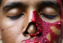 DU की छात्रा पर एसिड अटैक, तेजाब से झुलस गए दोनों हाथ…3 लड़कों ने किया हमला DELHI